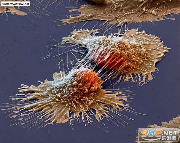 电子显微镜下的癌细胞